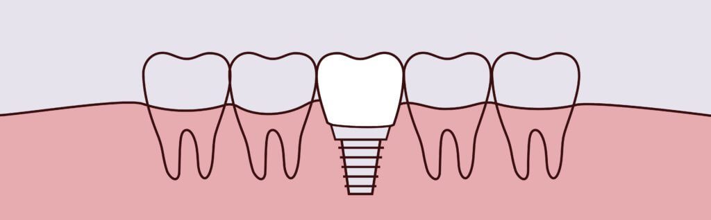 Dental Implants dental implants Matias Dental Group Dreamscape Imagery 05 1024x318 1 dental implants Matias Dental Group