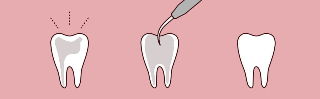Root Canal Therapy Matias Dental Group Dreamscape Imagery 10 1024x318 1 Matias Dental Group