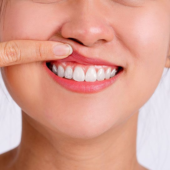 How Can I Defend Against Gum Recession? Matias Dental Group gum recession 2024 543 Matias Dental Group